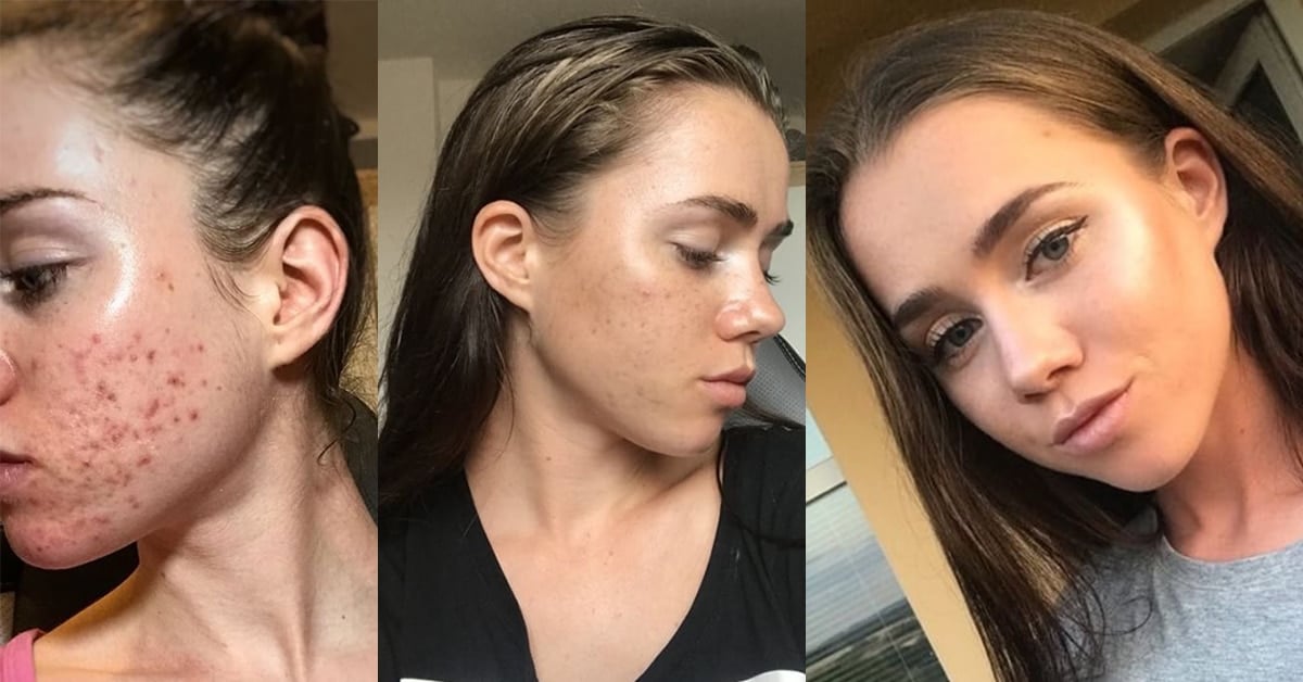 Jak se zbavit akné?